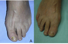 【健康科普】突破传统治疗！光动力治疗甲真菌病的最新进展