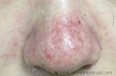 【健康科普】告别红鼻头