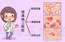 【护理日常】如何做好银屑病换着的心理护理