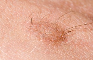 别让疥疮“偷袭”！皮肤科专家来支招