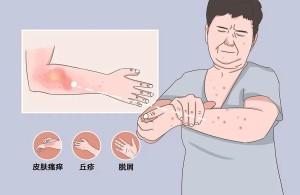 【健康科普】荨麻疹