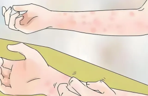 【健康科普】守护老年特异性皮炎患者的健康