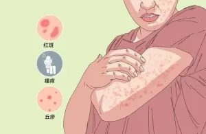 【健康科普】得了急性荨麻疹怎么办？