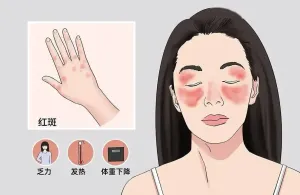 【健康科普】了解红斑狼疮