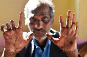 【健康科普】麻风病