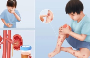【健康科普】过敏性紫癜