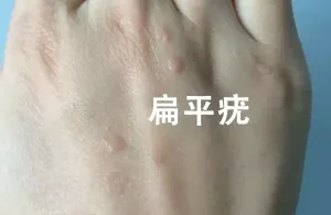 【健康科普】扁平疣：皮肤的“小麻烦”，你了解多少？
