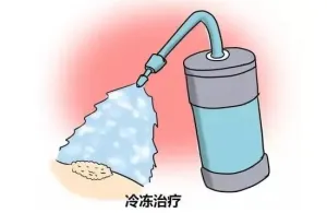 【健康科普】液氮冷冻：皮肤顽疾的“低温克星”