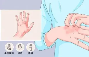 【健康科普】春季皮炎