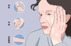 【健康科普】别让“白”困扰，带你全面认识白癜风