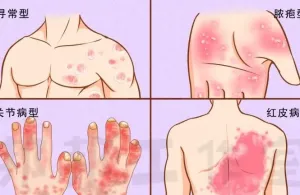 【健康科普】别让牛皮癣“缠上身”，一文读懂它