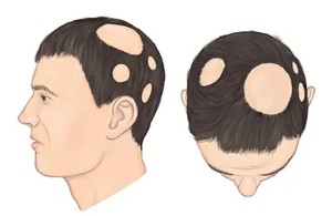 治疗斑秃新方案