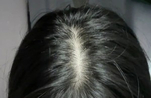 【健康科普】女生发缝越来越宽？别慌！这篇脱发科普帮你精准应对