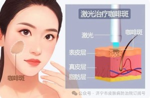 【健康科普】咖啡斑