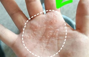 【健康科普】湿热天气易高发的皮肤病
