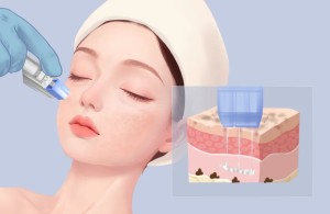 【健康科普】痘印痘坑的克星