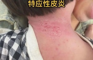 【健康科普】孩子‘痒’不停？科学应对儿童特应性皮炎