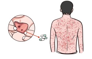 【健康科普】药疹