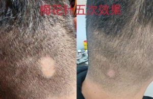 【健康科普】梅花针治斑秃