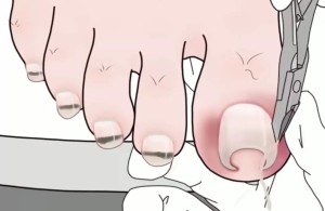【健康科普】灰指甲需要拔吗？