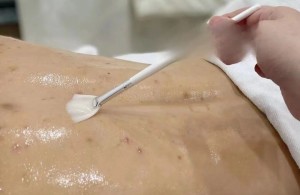 【健康科普】前胸后背长痘痘，科学刷酸告别烦恼
