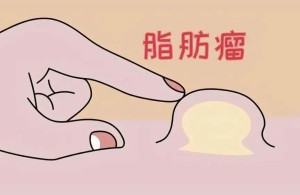 【健康科普】脂肪瘤
