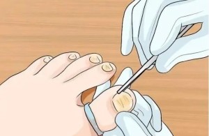 【健康科普】甲沟炎日常护理指南