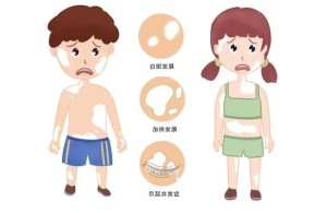 【健康科普】儿童白癜风：科学认知与应对指南 （中篇）