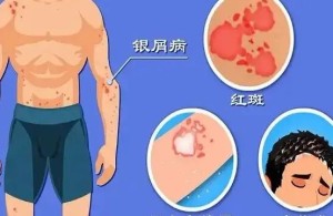 【健康科普】银屑病十大真相：告别误解，科学管理，拥抱健康生活