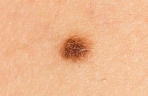 【健康科普】色素痣知多少？皮肤科医生教你科学认识与应对