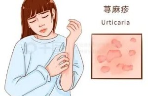 【健康科普】反复起风团、越抓越痒？2025版指南：难治性荨麻疹这样治才对