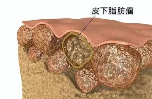 皮肤小肿物莫忽视