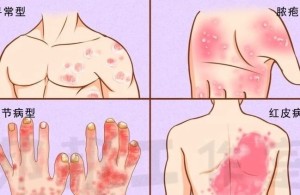 银屑病系列问答