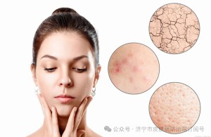 小心激素脸