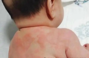 宝宝湿疹，外用药怎么选？