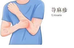 【健康科普】荨麻疹为啥越抓越重？