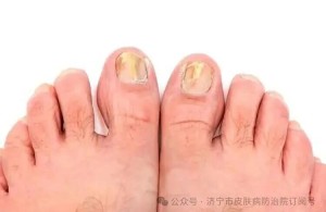 【甲癣专栏】第四讲：甲癣好了就万事大吉？预防复发更重要