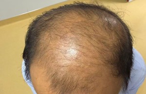 从试试看、满心期待到主动追问｜我院 CGF 生发新技术，让细软脱发悄悄逆袭