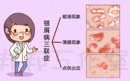【护理日常】如何做好银屑病换着的心理护理