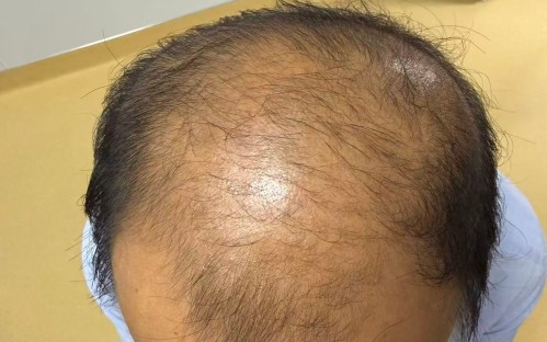 从试试看、满心期待到主动追问｜我院 CGF 生发新技术，让细软脱发悄悄逆袭